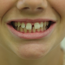 DIASTEMA-2-ortodoncia-myriam-solans-zaragoza