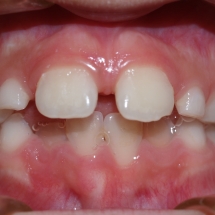 DIASTEMA-1-clinica-ortodoncia-myriam-solans-zaragoza