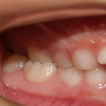 DIASTEMA-2-clinica-ortodoncia-myriam-solans
