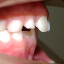 DIASTEMA-3-clinica-ortodoncia-myriam-solans
