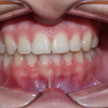 DIASTEMA-4-clinica-ortodoncia-myriam-solans-zaragoza