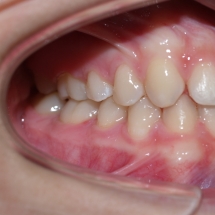 DIASTEMA-5-clinica-ortodoncia-myriam-solans-zaragoza