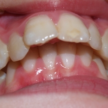 protusion-2-maxilar-ortodoncia-myriam-solans-zaragoza