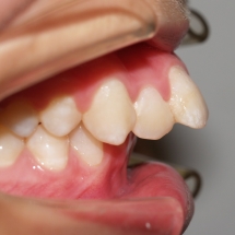 protusion-5-maxilar-ortodoncia-myriam-solans-zaragoza