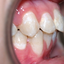 protusion-6-maxilar-ortodoncia-myriam-solans